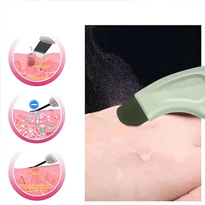 Herramienta de Limpieza Profunda Facial (Extractor de Puntos Negros y Espinillas para la Nariz y el Cuidado de la Piel)